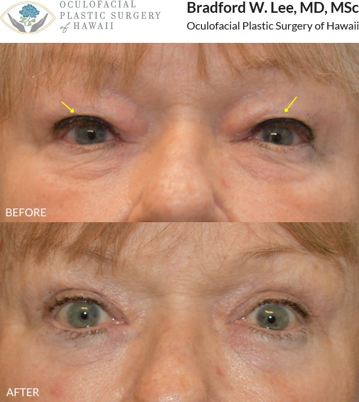 This 70+ year-old patient was bothered by drooping upper eyelids that were affecting her vision and often found herself manually lifting her eyelids to see more clearly. She underwent an upper blepharoplasty to remove excess skin and fat from the upper eyelids, improving her vision while creating a more defined, naturally refreshed eyelid contour.