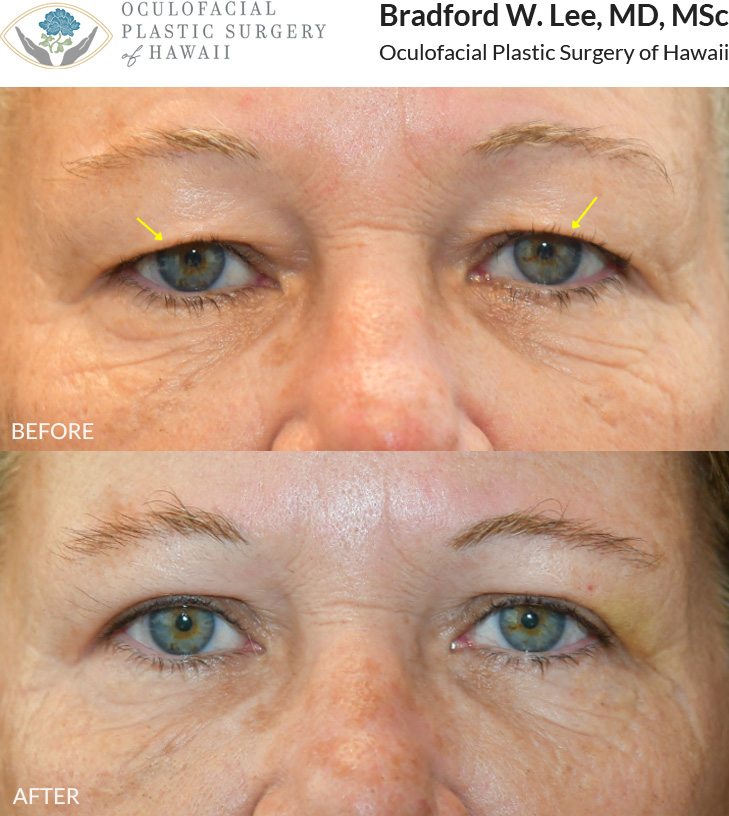 This patient in her 50s was bothered by drooping upper eyelids that felt heavy and often found herself manually lifting her eyelids to see more clearly. She underwent an upper blepharoplasty to remove the excess skin resting on her lashes, improving her vision while creating a naturally refreshed appearance.