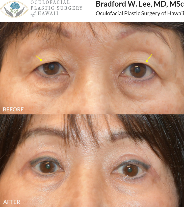 This 70+ year-old patient was bothered by heavy upper eyelids that were affecting her daily activities, including reading and driving. She underwent an upper blepharoplasty to remove excess skin and fat and refine her eyelid crease.