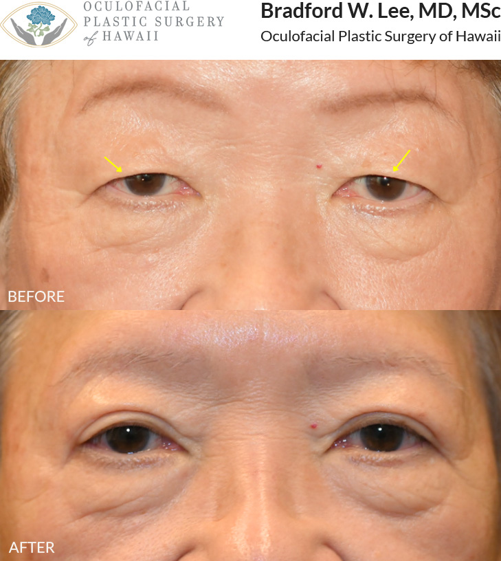 This 70+ year-old patient was bothered by drooping upper eyelids that were interfering with daily activities such as reading and driving. She underwent an upper blepharoplasty to remove excess skin, improving her vision while defining her eyelid crease.