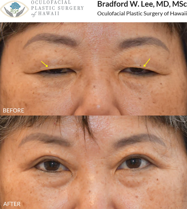 This 60+ year-old patient was bothered by heavy, drooping upper eyelids that were affecting daily activities such as reading and driving. She underwent an upper blepharoplasty to remove excess skin and fat from the upper eyelids, improving her vision while creating a more defined, natural-looking eyelid crease.