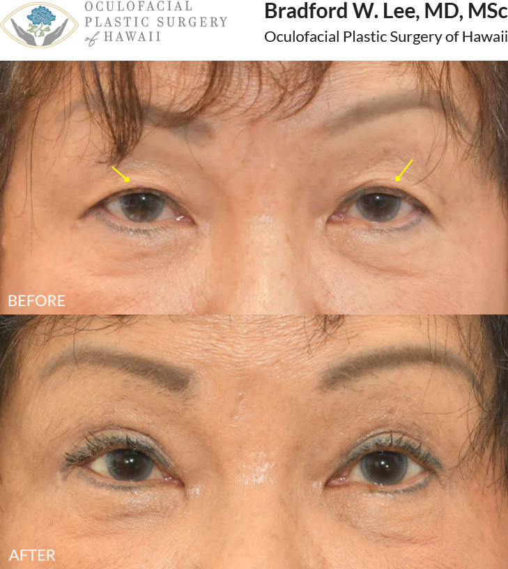 This patient in her 70s was bothered by heavy upper eyelids that were affecting daily actitivies such as reading and driving. She underwent an upper blepharoplasty to remove excess skin and refine her eyelid crease.
