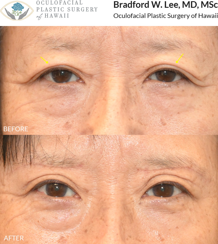 This patient in her 60s was bothered by heavy upper eyelids that were affecting her vision and often found herself manually lifting her eyelids to see more clearly. She underwent a sub-brow upper blepharoplasty to remove excess skin and fat while preserving her natural eyelid anatomy, improving her vision and creating a naturally refreshed appearance.