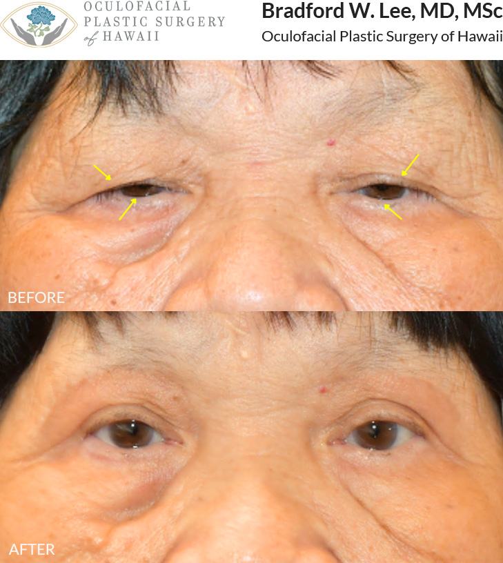 This 70+ year-old patient was bothered by drooping upper eyelids that affected their vision, as well as irritation caused by the lower eyelid lashes rubbing against the eyes. They underwent an upper blepharoplasty to remove excess upper eyelid skin and improve their visual field, along with a trichiasis repair to correct the inward-turning lashes and relieve discomfort from the lower eyelids.