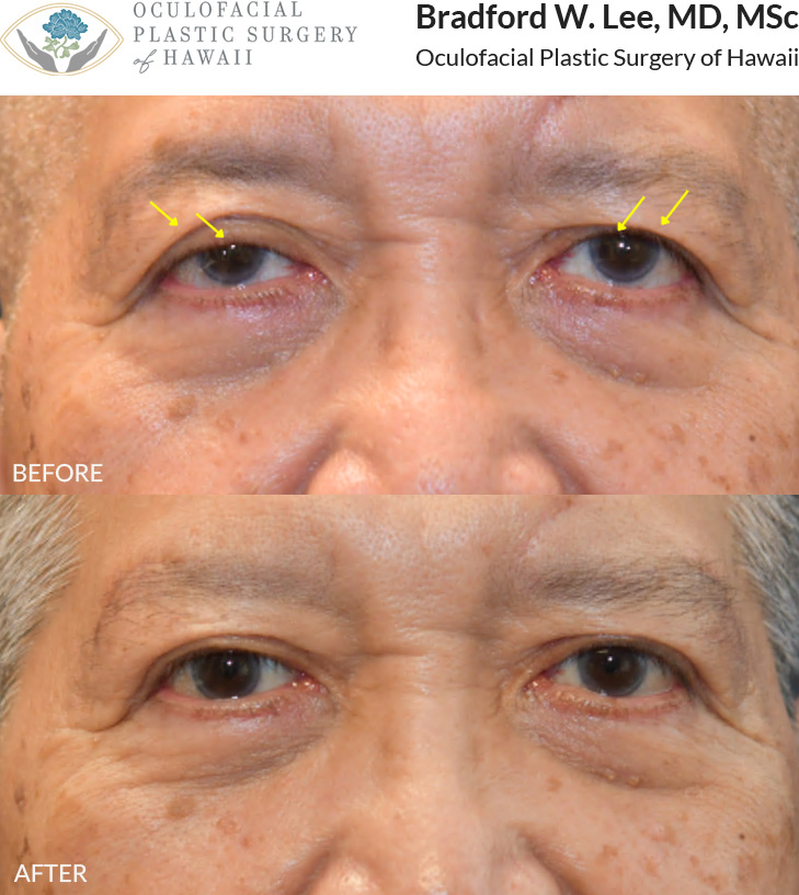 This 60+ year-old patient was bothered by drooping upper eyelids that were affecting his vision and creating a tired appearance. He underwent an upper blepharoplasty to remove excess skin, along with a ptosis repair and direct brow lift to further elevate the upper eyelids and brows. Together, these procedures improved his visual field while creating a more refreshed appearance.