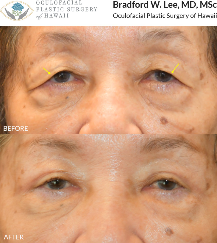 This 80+ year-old patient was bothered by drooping upper eyelids that affected her vision, requiring her to manually lift her eyelids to see more clearly. She underwent an upper blepharoplasty to remove excess skin and fat, restoring a clearer visual field.