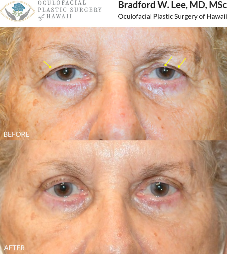 This 80+ year-old patient was bothered by heavy upper eyelids that were affecting her vision. She underwent an upper blepharoplasty to remove excess skin, along with a left direct brow lift to further elevate the left brow and improve her visual field.