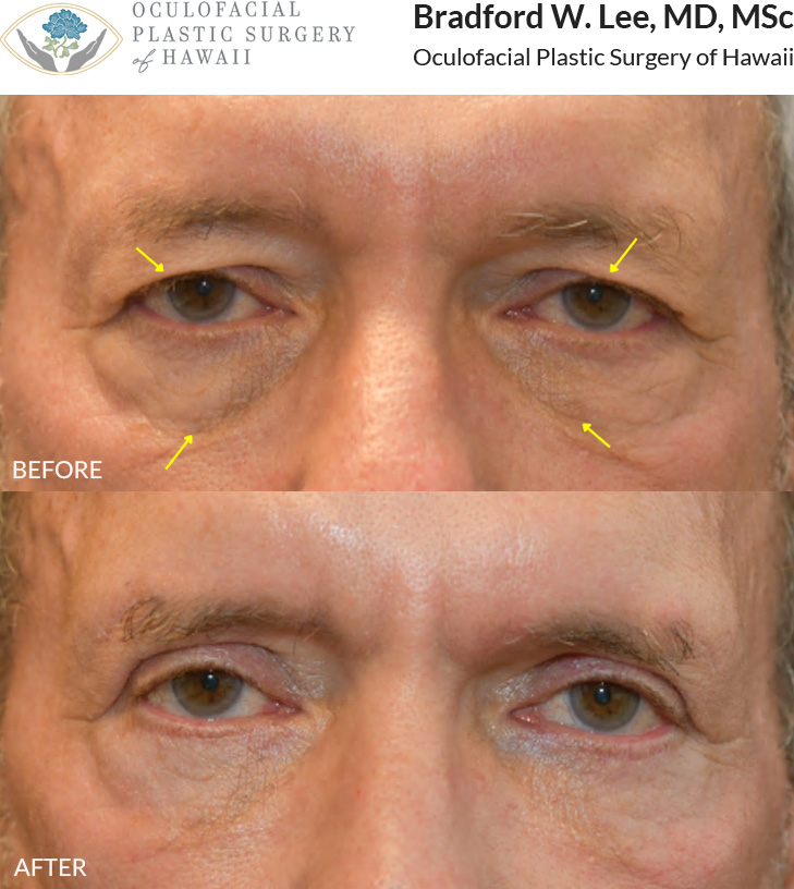 This 60+ year-old patient was bothered by heavy upper eyelids that were affecting his vision, as well as puffiness and hollowing of the lower eyelids. He underwent an upper and lower (quad) blepharoplasty to remove excess skin and reposition or remove excess fat, along with a direct brow lift to further elevate the brows and improve his visual field. These procedures helped restore a more open, refreshed appearance while maintaining a natural look.