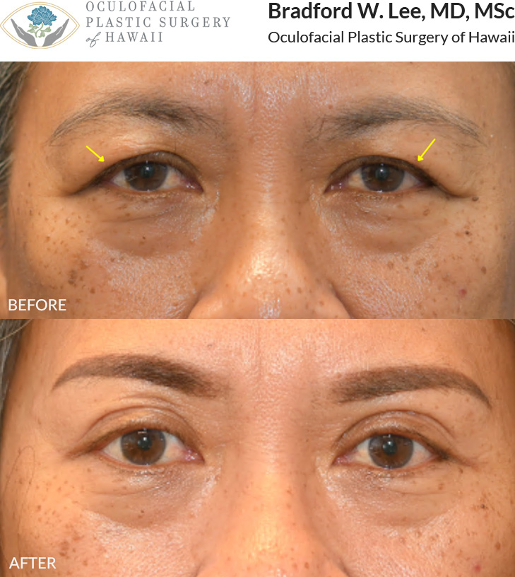 This 50+ year-old patient was bothered by heavy upper eyelids that were affecting her vision. She underwent an upper blepharoplasty to remove excess skin and fat, improving her visual field while creating a more refreshed and brighter appearance.