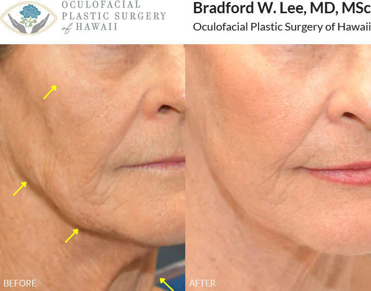 This patient was bothered by textural wrinkles, as well as gravitational changes and laxity of the face and neck. She underwent a face and neck lift to improve facial contour and definition, along with an UltraClear® laser treatment to smooth and brighten the skin, creating a more refreshed and rejuvenated appearance.