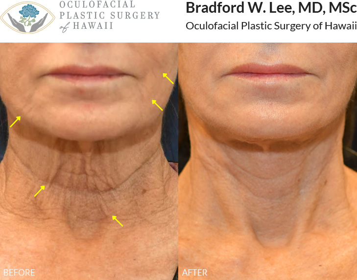 This patient was bothered by jowling, facial descent, and loose skin around the neck. She underwent a mini facelift and neck lift to restore definition to the cheeks and lower face, soften the appearance of the jowls and smile lines, and improve the contour of the neck for a naturally refreshed appearance.