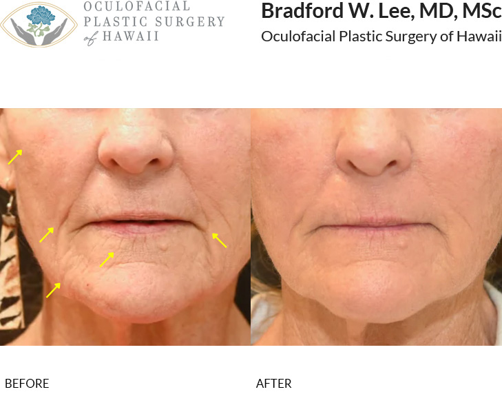 This patient was bothered by deep wrinkles, skin texture concerns, and gravitational descent of the lower face. She underwent a mini facelift with UltraClear laser skin resurfacing to the perioral region to rejuvenate the lower face, soften deep wrinkles, and improve overall skin texture for a more refreshed and rejuvenated appearance.