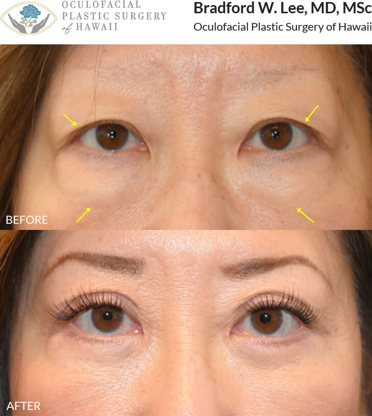 This 60+ year-old patient was bothered by upper eyelid hooding and puffiness under the eyes. She underwent an upper and lower (quad) blepharoplasty to remove excess skin and fat, defining her eyelid crease and smoothing out the under-eye region.