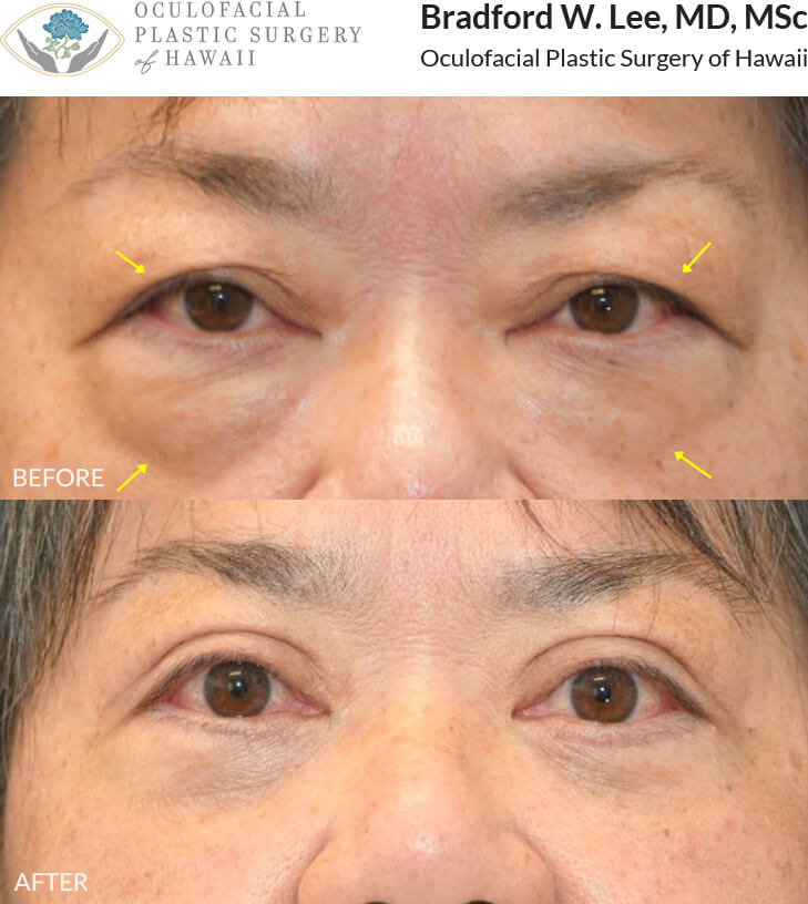 This patient in her mid to late 60s was bothered by the puffiness of her upper eyelids and under-eye “bags.” She underwent an upper and lower (quad) blepharoplasty to remove excess skin and fat, resulting in a smoother under-eye contour and a more youthful, refreshed appearance.