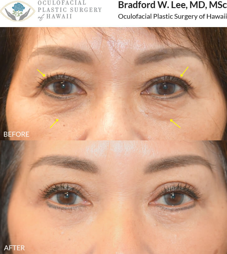 This patient in her 60s was bothered by excess skin of the upper eyelids and under-eye region, which contributed to a tired, aged appearance. She underwent an upper and lower (quad) blepharoplasty to address these concerns, resulting in a smooth under-eye contour and a more youthful, refreshed appearance.