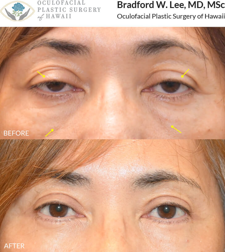 This 60+ year-old patient was bothered by drooping and heaviness of her upper eyelids, which affected her vision and interfered with daily activities. She was also interested in improving the appearance of her under-eyes. She underwent an upper and lower (quad) blepharoplasty with ptosis repair to remove excess upper eyelid skin and enhance her vision, while smoothing and rejuvenating her under-eyes.