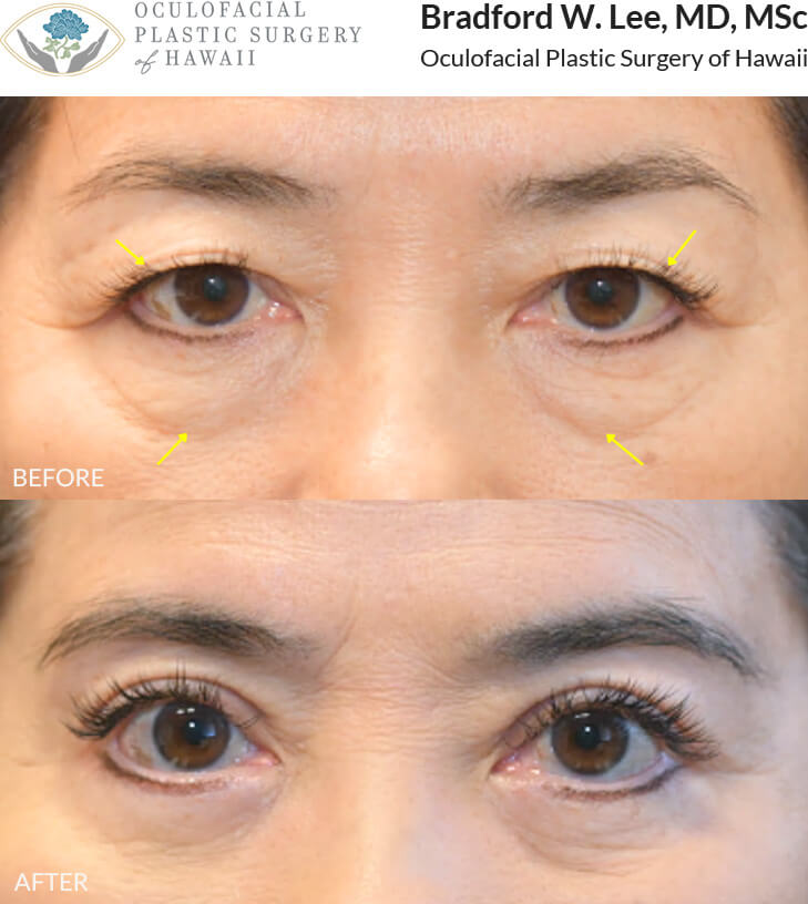This patient in her 60s was bothered by drooping upper eyelids that rested on her lashes and by the appearance of under-eye “bags.” She underwent an upper and lower (quad) blepharoplasty to remove excess skin and fat from both the upper and lower eyelids, enhancing her eyelid crease and natural contours.