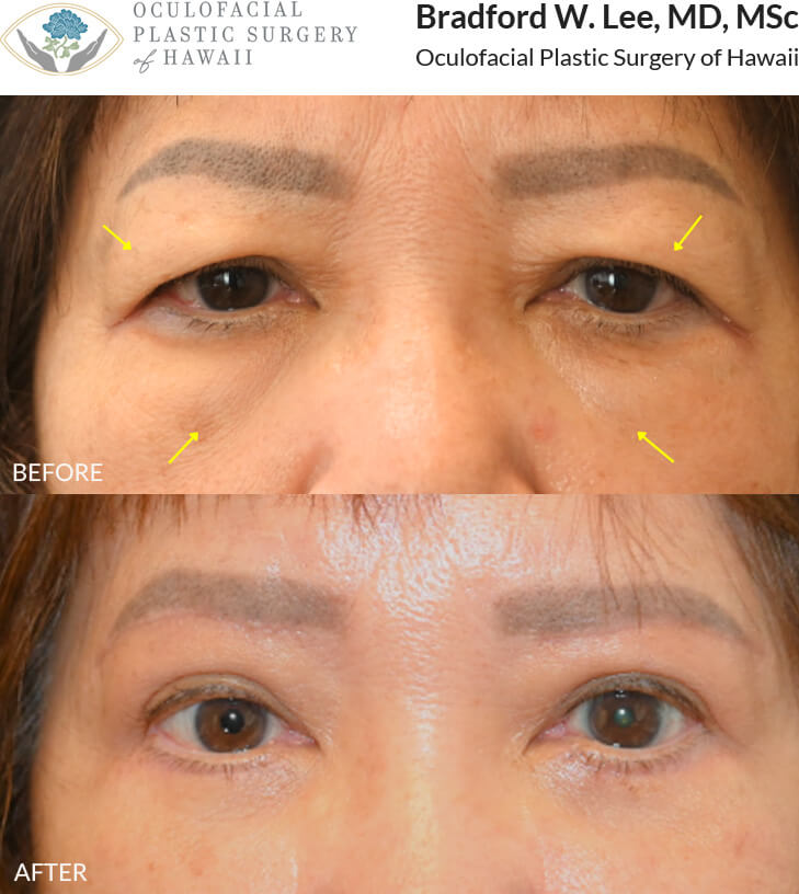 This 70+ year-old patient was bothered by heavy upper eyelids that were affecting her vision and ability to carryout daily acitivities such as reading and driving. She was also bothered by the puffy appearance of her under eyes. She underwent an upper and lower (quad) blepharoplasty.