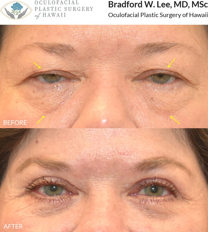 This 60+ year-old patient was bothered by heavy upper eyelids that were affecting her vision and giving her a tired and aged appearance. She was also bothered by the puffiness under her eyes. She underwent an upper and lower (quad) blepharoplasty with a brow lift to lift the upper eyelids and restore the youthful contours of her eyes.
