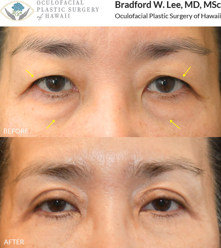 This 50+ year-old patient was bothered by excess skin on her upper eyelids weighing on her eyelashes, as well as puffiness in the under-eye area. She underwent an upper and lower (quad) blepharoplasty to address these concerns, resulting in a more defined eyelid crease and a smoother under-eye contour.