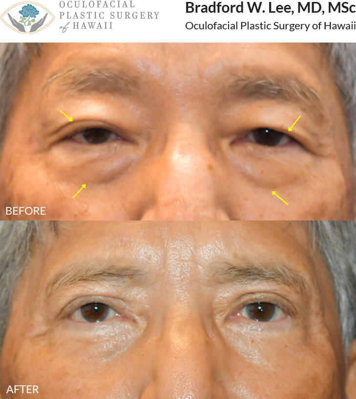 This 70+ year-old patient was concerned about drooping upper eyelids and puffiness beneath his eyes. He underwent upper and lower (quad) blepharoplasty to remove excess skin and fat, along with a right ptosis repair to further elevate the right upper eyelid for improved symmetry and a more refreshed appearance.