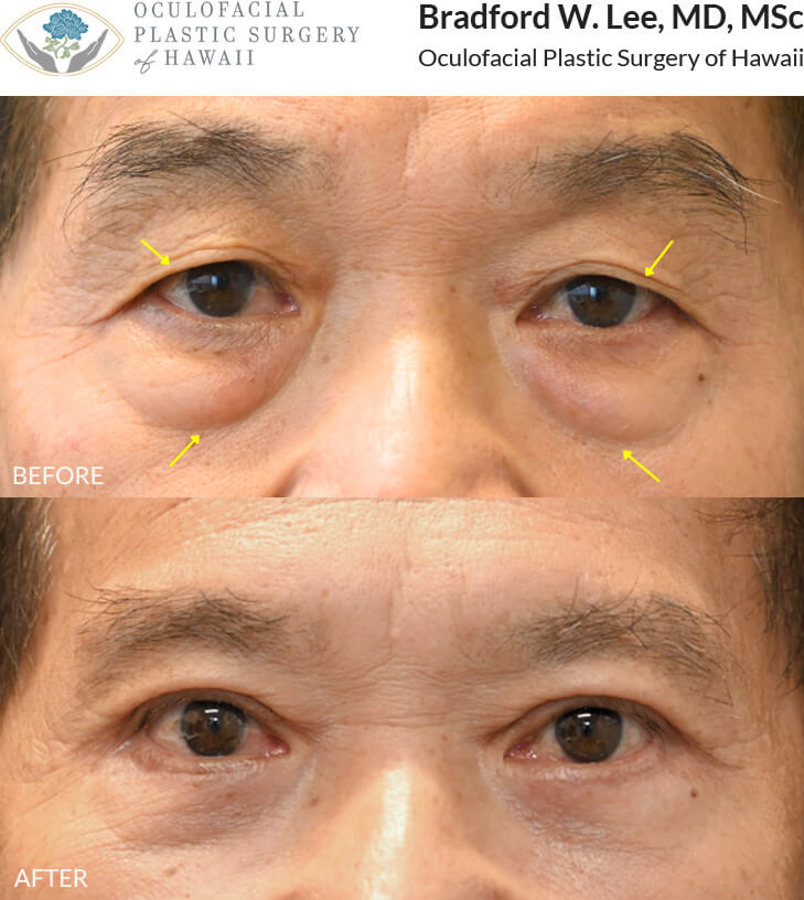 This patient in his 70s was bothered by drooping upper eyelids and the puffiness of his undereyes. He underwent an upper and lower (quad) blepharoplasty to remove any excess skin and fat amd restore the natural contours of his eyes.
