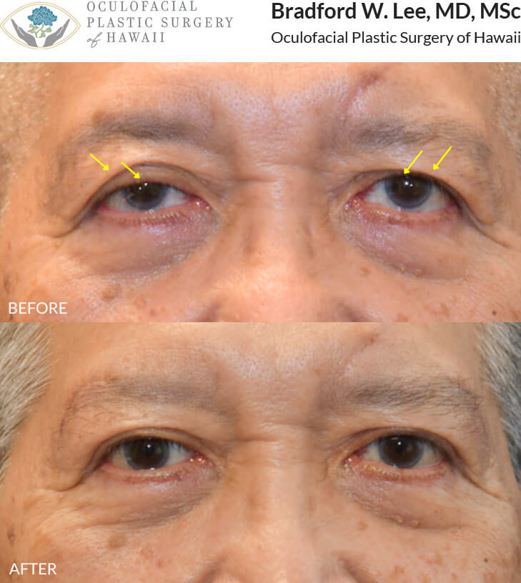 This 60+ year-old patient was bothered by drooping upper eyelids that were affecting his vision and creating a tired appearance. He underwent an upper blepharoplasty to remove excess skin, along with a ptosis repair and direct brow lift to further elevate the upper eyelids and brows. Together, these procedures improved his visual field while creating a more refreshed appearance.