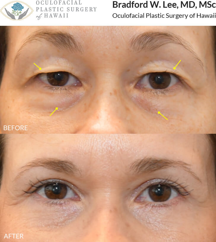 This patient in her mid 40s experienced upper eyelid drooping that interfered with everyday activities, including reading and driving. She was also troubled by under-eye puffiness that gave her a fatigued appearance. She underwent an upper and lower (quad) blepharoplasty to address excess skin and fat of the upper and lower eyelids, rejuvenating the periocular area and giving her a more youthful glow.