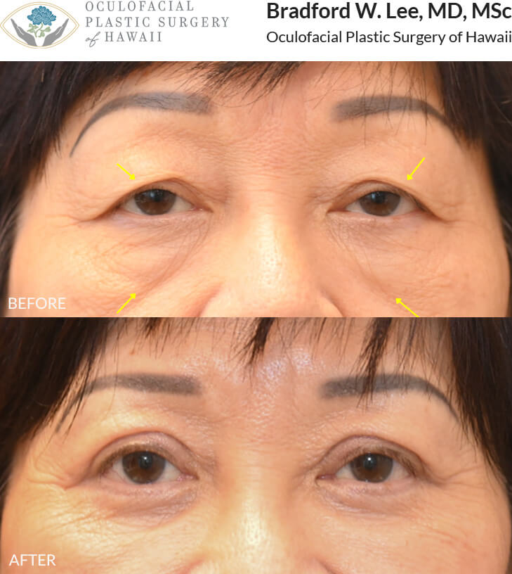 This patient in her 70s was concerned about drooping upper eyelids affecting her vision and the appearance of under-eye 