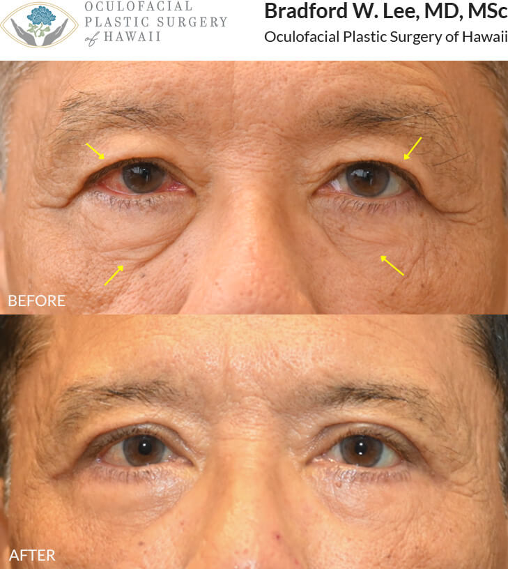 This patient in his mid to late 60s was bothered by heavy upper eyelids that affected his vision, as well as the appearance of under-eye bags. He underwent an upper and lower (quad) blepharoplasty to remove excess skin and fat from both the upper and lower eyelids, restoring his visual field and creating a brighter, smoother, and more balanced eyelid contour.