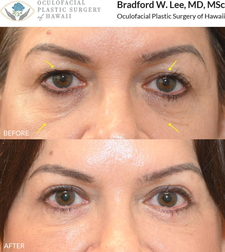 This patient in her 60s was concerned about heavy upper eyelids that rested on her lashes and hollowing beneath the eyes. She underwent an upper and lower (quad) blepharoplasty to improve the contours of the upper and lower eyelids and create a brighter, more rejuvenated appearance.