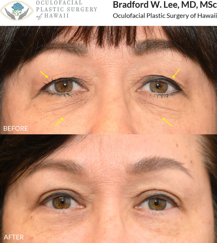 This 60+ year-old patient was bothered by excess skin on both the upper and lower eyelids that made her eyes appear tired and aged. She underwent an upper and lower (quad) blepharoplasty to remove excess skin and fat, creating a more open, refreshed, and youthful appearance.