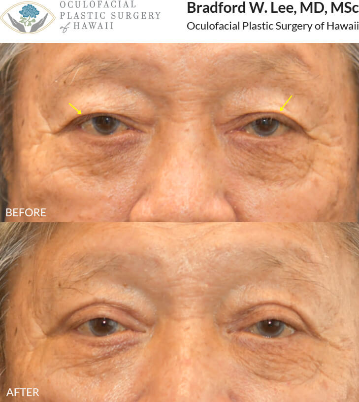 This 70+ year-old patient was experiencing drooping upper eyelids that were affecting everyday activities like reading and driving. He underwent an upper blepharoplasty to remove the excess skin and fat that were obstructing his vision, resulting in improved visual function and a more refreshed appearance.