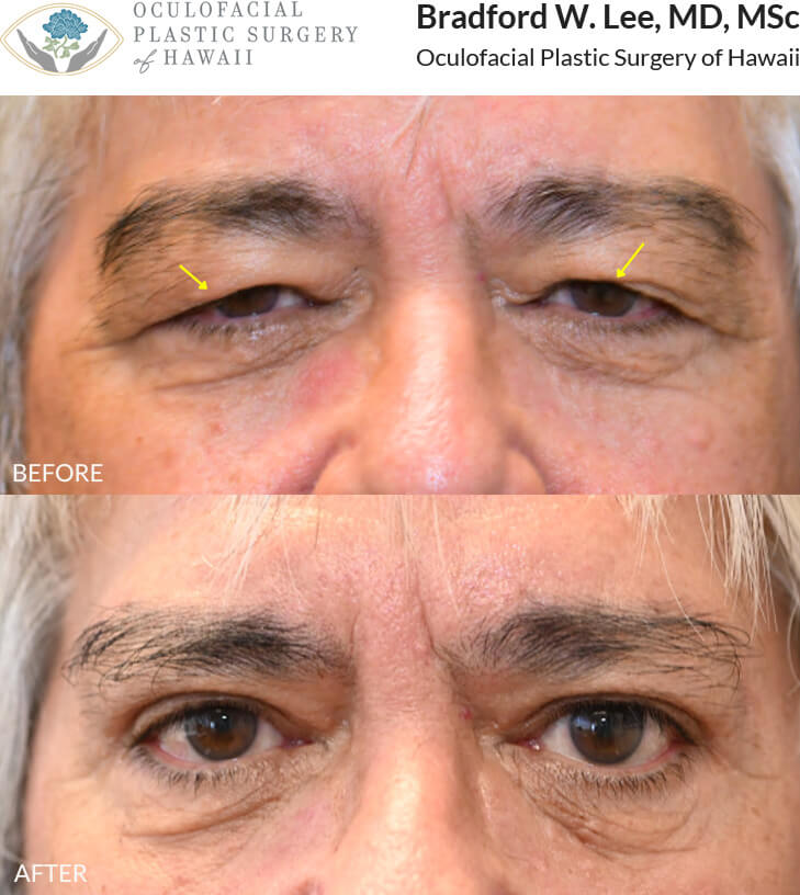 This 70+ year-old patient was bothered by the heaviness and drooping of his upper eyelids, which were affecting daily activities such as reading and driving. He underwent an upper blepharoplasty to remove the excess skin and fat weighing down his eyelids, as well as a direct brow lift to further elevate the brows and restore his visual field. The result was improved vision and a brighter, more refreshed appearance.