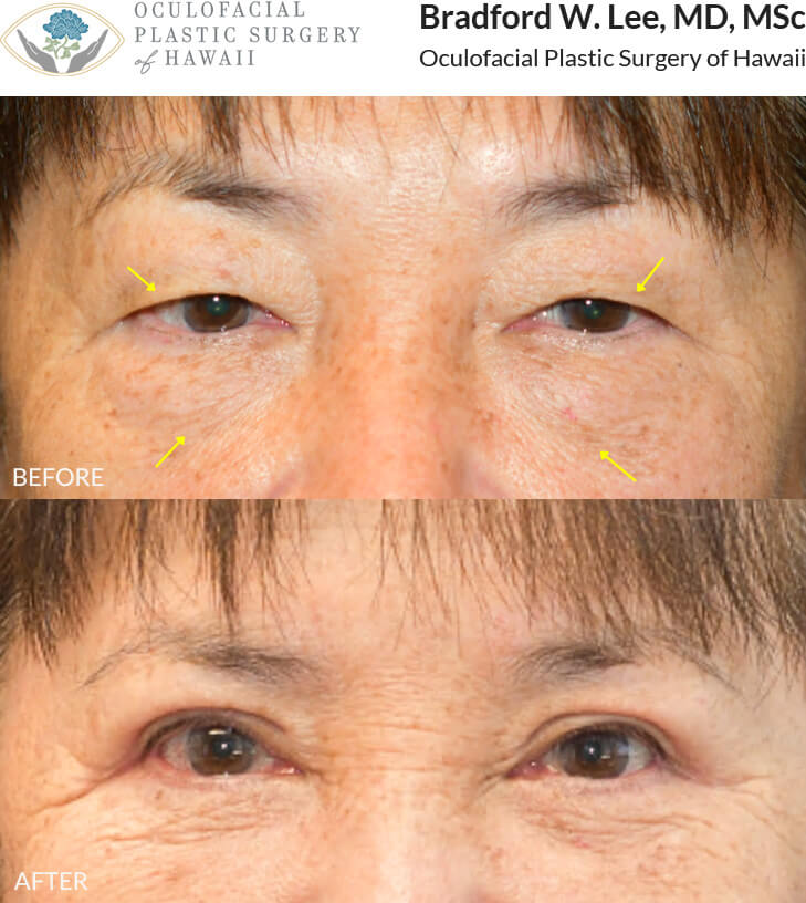 This patient in her 60s was bothered by upper eyelid hooding that interfered with her vision, as well as puffiness in the undereye region. She underwent an upper and lower (quad) blepharoplasty to remove excess skin and fat and restore her vision.