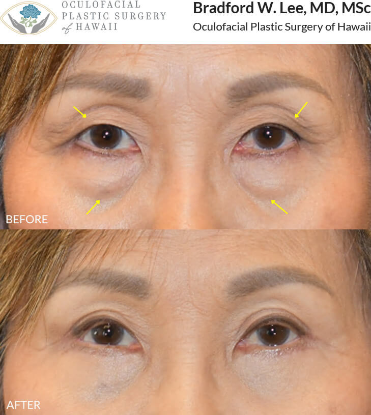 The patient in her early 70s was bothered by heaviness of the upper eyelids and puffiness of the lower eyelids. She underwent upper and lower (quad) blepharoplasty to smooth the under-eye region and improve her visual field, resulting in a more youthful and refreshed appearance.