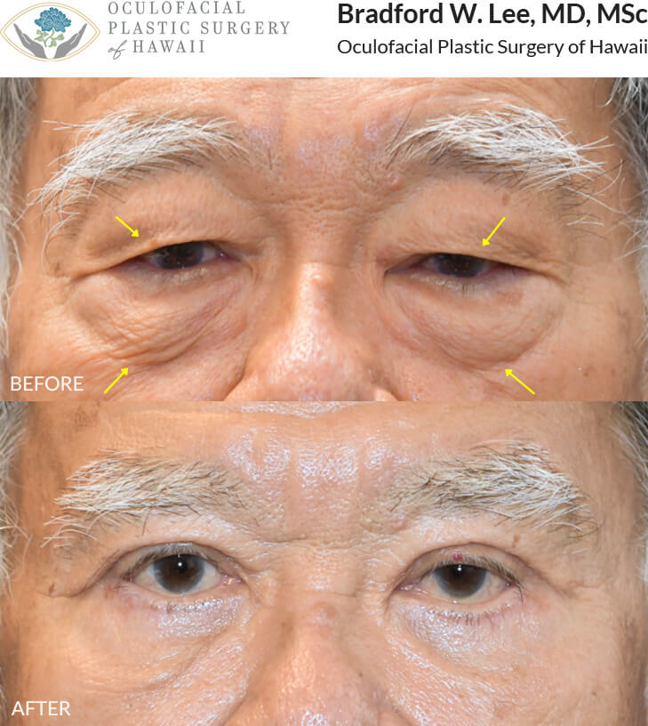 This patient in his 70s was concerned about heavy upper eyelids that interfered with his vision and puffiness of the lower eyelids. He underwent an upper and lower (quad) blepharoplasty to remove excess skin and fat, giving him a smoother and brighter look.