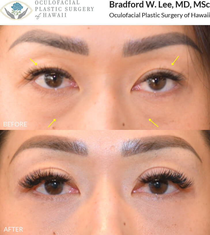 This 30+ year-old patient was bothered by eyelid asymmetry and wanted to enhance the appearance of her double eyelid crease. She was also bothered by hollowing under her eyes. She underwent an upper and lower (quad) blepharoplasty to remove excess skin, define the eyelid crease, and smooth the under-eye area.