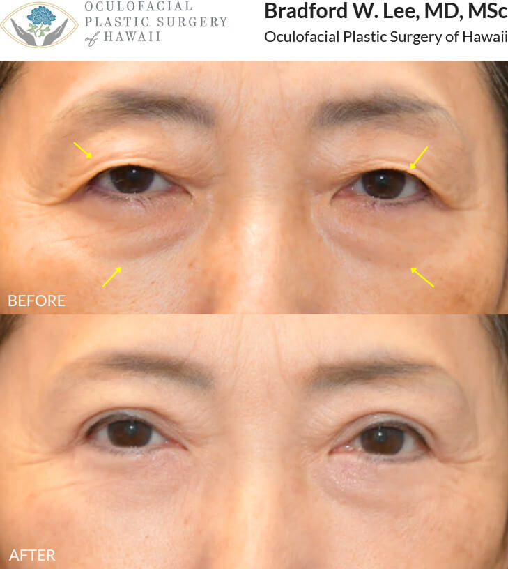 This 60+ year-old patient was bothered by excess skin on her upper eyelids which rested on her lashes, contributing to a tired, aged appearance. She was also bothered by the appearance of her under-eye “bags.” She underwent an upper and lower (quad) blepharoplasty to remove excess skin and fat from the upper eyelids and under-eye region, resulting in improved definition and reduced signs of aging.