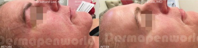 microneedling before after image1