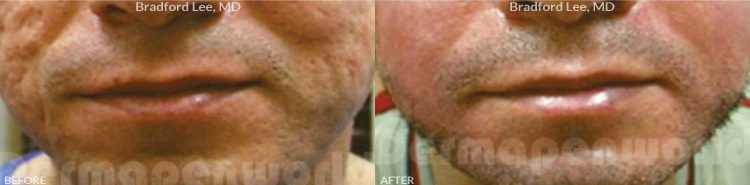 microneedling before after image2